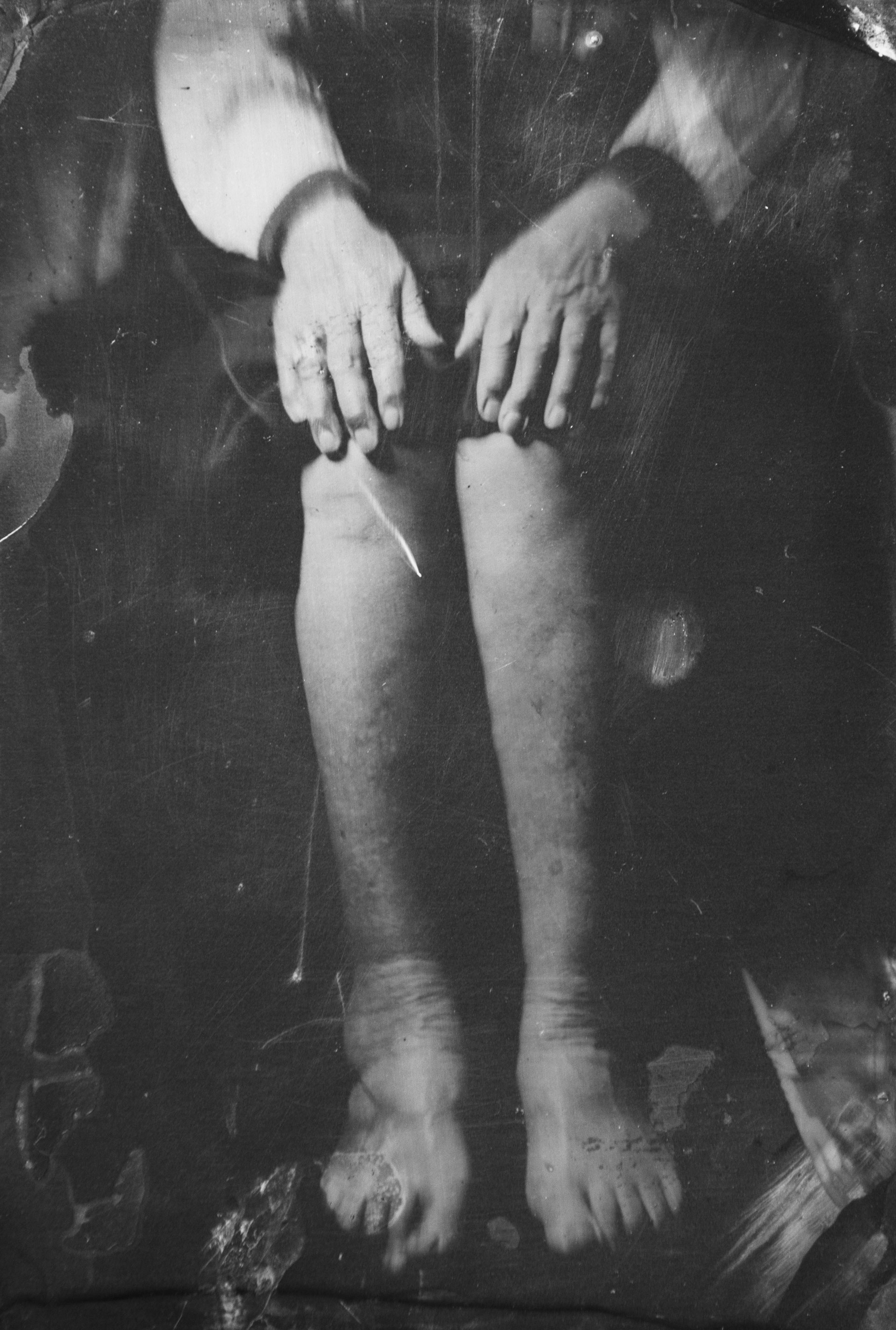 Collodion
